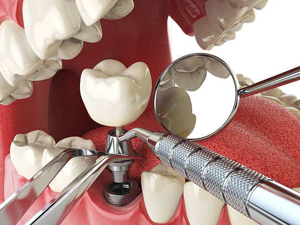 Best Chipped Tooth Repair Near Me  in Riverdale, CA